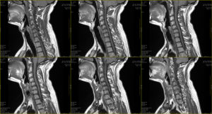 Emerson Straw PL, Personal Injury, Medical Malpractice & Car Accident Attorneys Saint Petersburg, FL Office